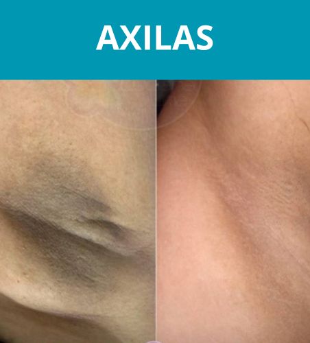 AXILAS (1)