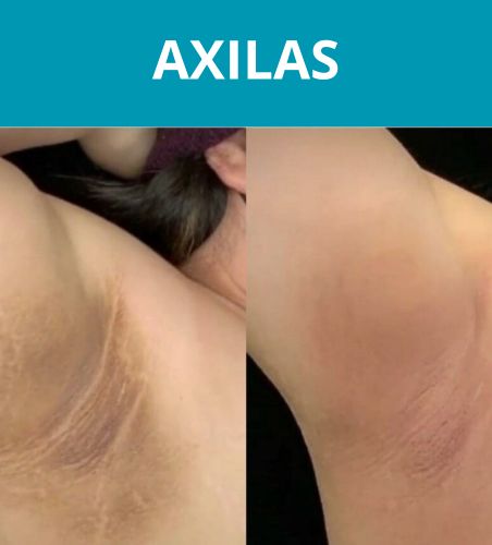 AXILAS (2)